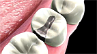 Amalgam Filling