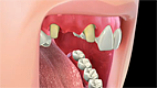 Dental Bridge