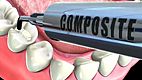 Composite Filling