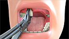 Tooth Extraction