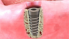 Implant for Crown & Bridge