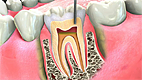 Root Canal